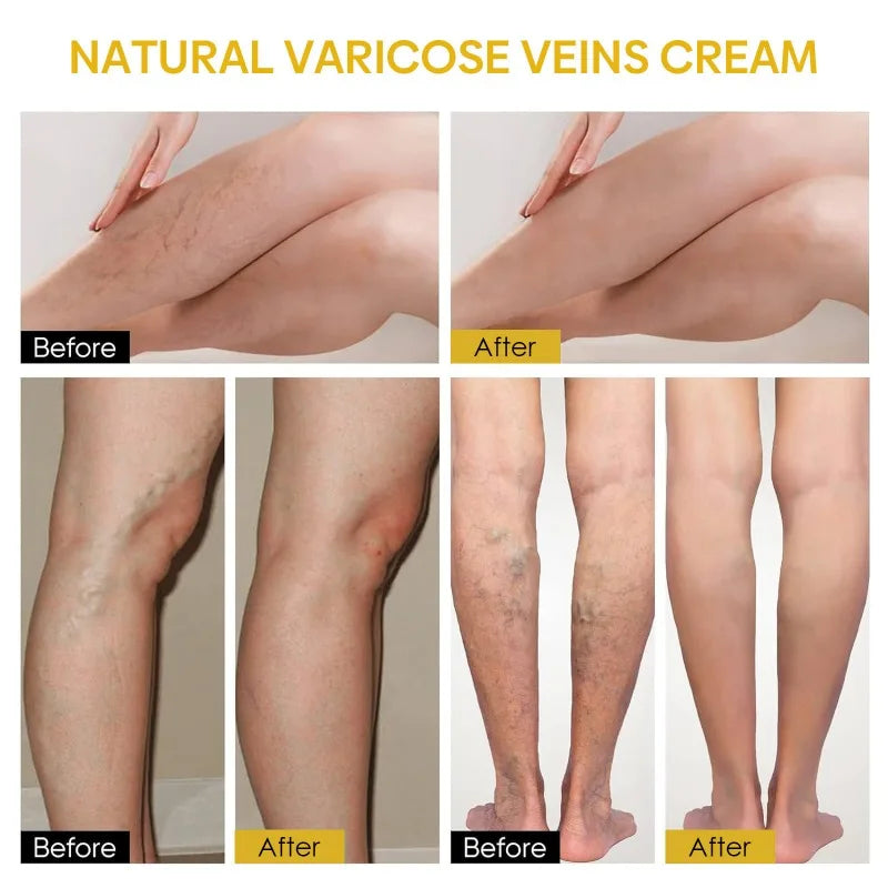 ApiLift™ | Bee Venom Varicose Vein Cream